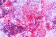  Examining the Expression of miR-205 and CEA mRNA in Peripheral Blood of Patients with OSCC(Oral Squamous Cell Carcinomas) and Comparing them with Healthy People 