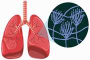 The Identification of Cytochrome B5 Reductase 2 and Fructose-1,6-Bisphosphatase 1 Proteins in Non-Small Cell Lung Cancer: Proteomics Approach