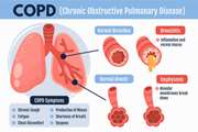 Expression Profile and Relationships between microRNAs as Biomarkers in COPD Patients