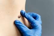 Comparing the Expression Levels of GCG and FBN 1 in the Plasma of  Patients with Basal Cell Carcinoma (BCC) and Healthy Individuals