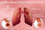 Investigating the Presence of Haemophilus Influenzae in Patients with Chronic Obstructive Pulmonary Disease (COPD) Using Molecular Method