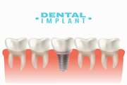  APPLICATION AND ANALYSIS OF CUSTOMIZED BONE GRAFT OF A PATIENT UNDERGOING MANDIBLE AUGMENTATION AND DENTAL IMPLANTATION