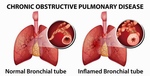 Molecular Detection of Chlamydia pneumoniae, Haemophilus influenza, and Streptococcus pneumoniae and Expression of miR-146, miR-16, and miR-221 in Patients with Chronic Obstructive Pulmonary Diseases