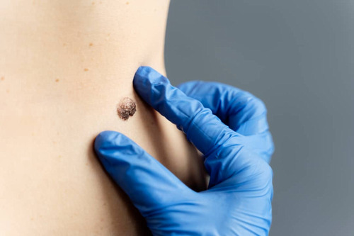 Comparing the Expression Levels of GCG and FBN 1 in the Plasma of  Patients with Basal Cell Carcinoma (BCC) and Healthy Individuals
